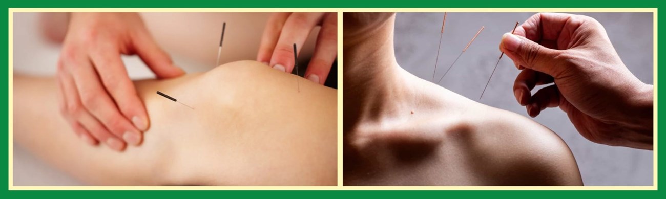Pain management acupuncture in Ashbourne and Dunshaughlin - Acupuncture Ashbourne